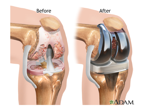 knee replacement before and after